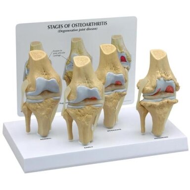 4 pakopų osteoporozinio kelio modelių komplektas 4 pakopų osteoporozinio kelio modelių komplektas