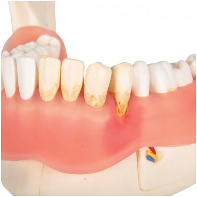 Dantų ligų modelis, 2x padidintas, 21 dalis 5