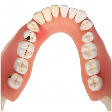 Dantų ligų modelis, 2x padidintas, 21 dalis 7