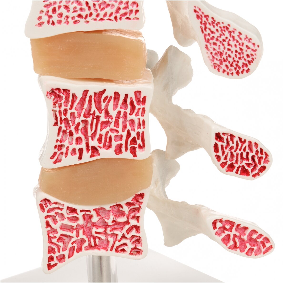 Deluxe žmogaus osteoporozės modelis (3 slanksteliai su diskais) , nuimamas ant stovo 5 Deluxe žmogaus osteoporozės modelis (3 slanksteliai su diskais) , nuimamas ant stovo 5