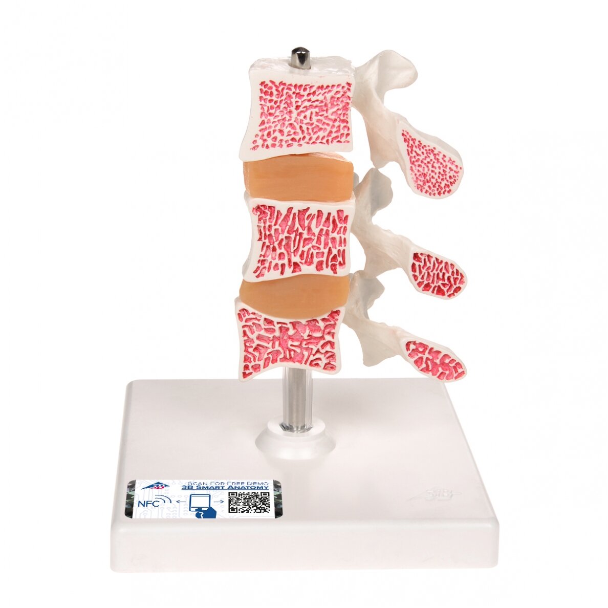 Deluxe žmogaus osteoporozės modelis (3 slanksteliai su diskais) , nuimamas ant stovo Deluxe žmogaus osteoporozės modelis (3 slanksteliai su diskais) , nuimamas ant stovo