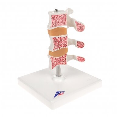 Deluxe žmogaus osteoporozės modelis (3 slanksteliai su diskais) , nuimamas ant stovo 2 Deluxe žmogaus osteoporozės modelis (3 slanksteliai su diskais) , nuimamas ant stovo 2