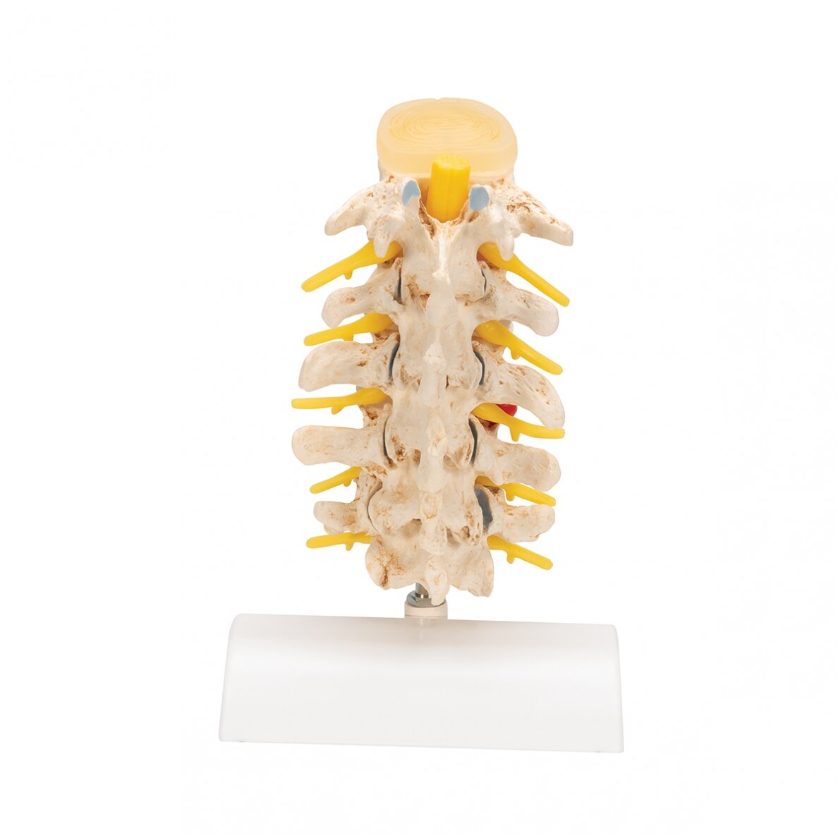 Diskų prolapso ir slankstelių degeneracijos modelis 4 Diskų prolapso ir slankstelių degeneracijos modelis 4