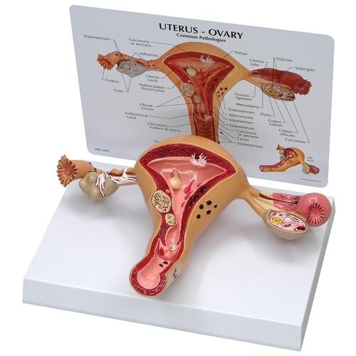 Gimdos ir kiaušidžių modelis su patologijomis