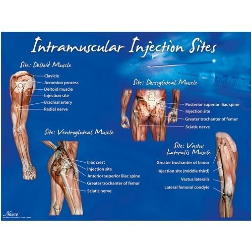 Injekcijos į raumenį vietų plakatas