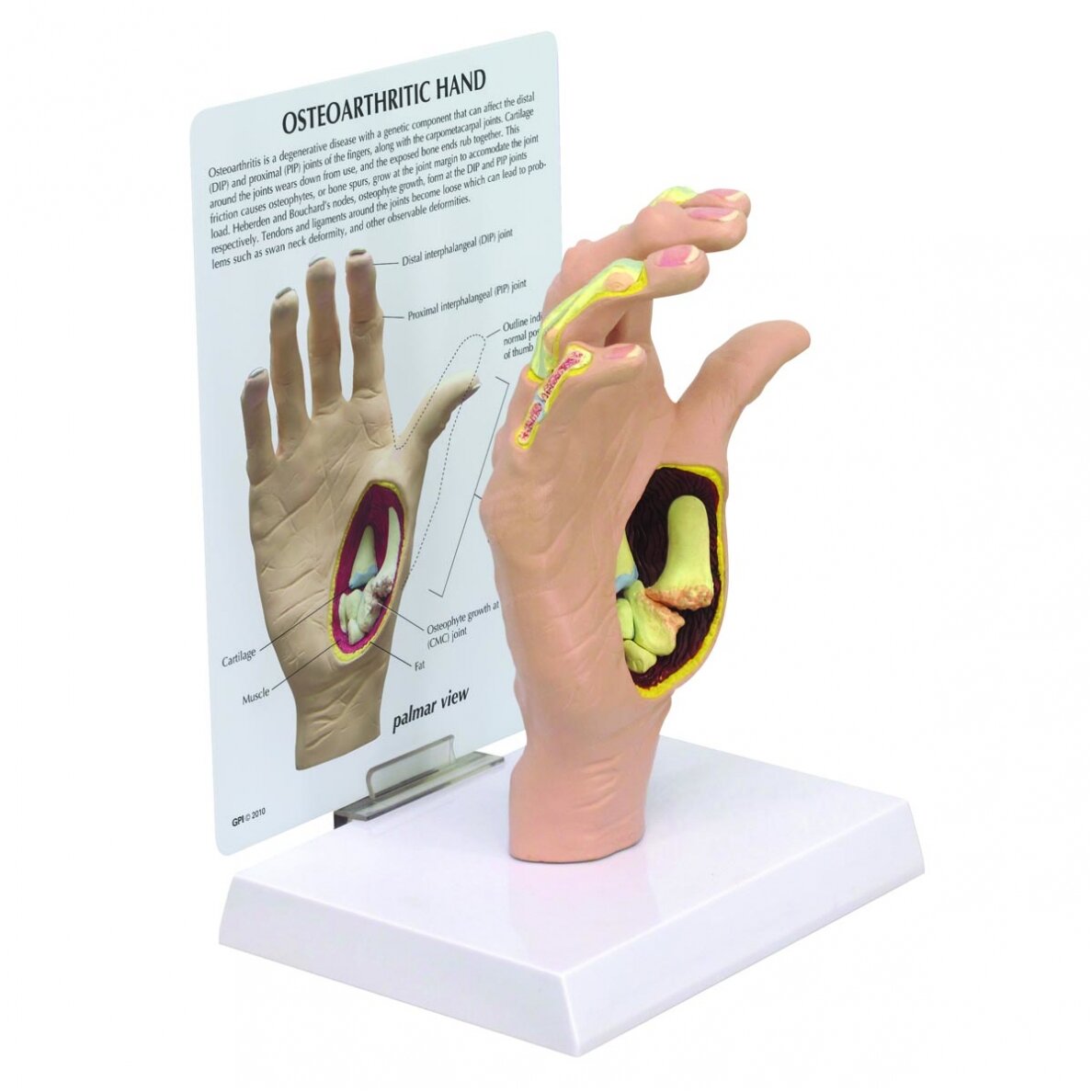Osteoartritinės rankos modelis Osteoartritinės rankos modelis