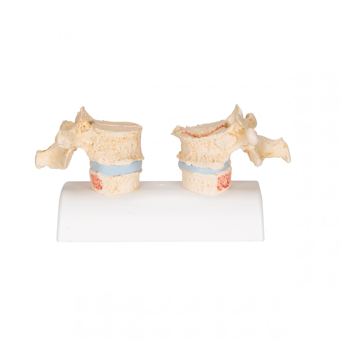 Osteoporozės didaktinis modelis 4 Osteoporozės didaktinis modelis 4