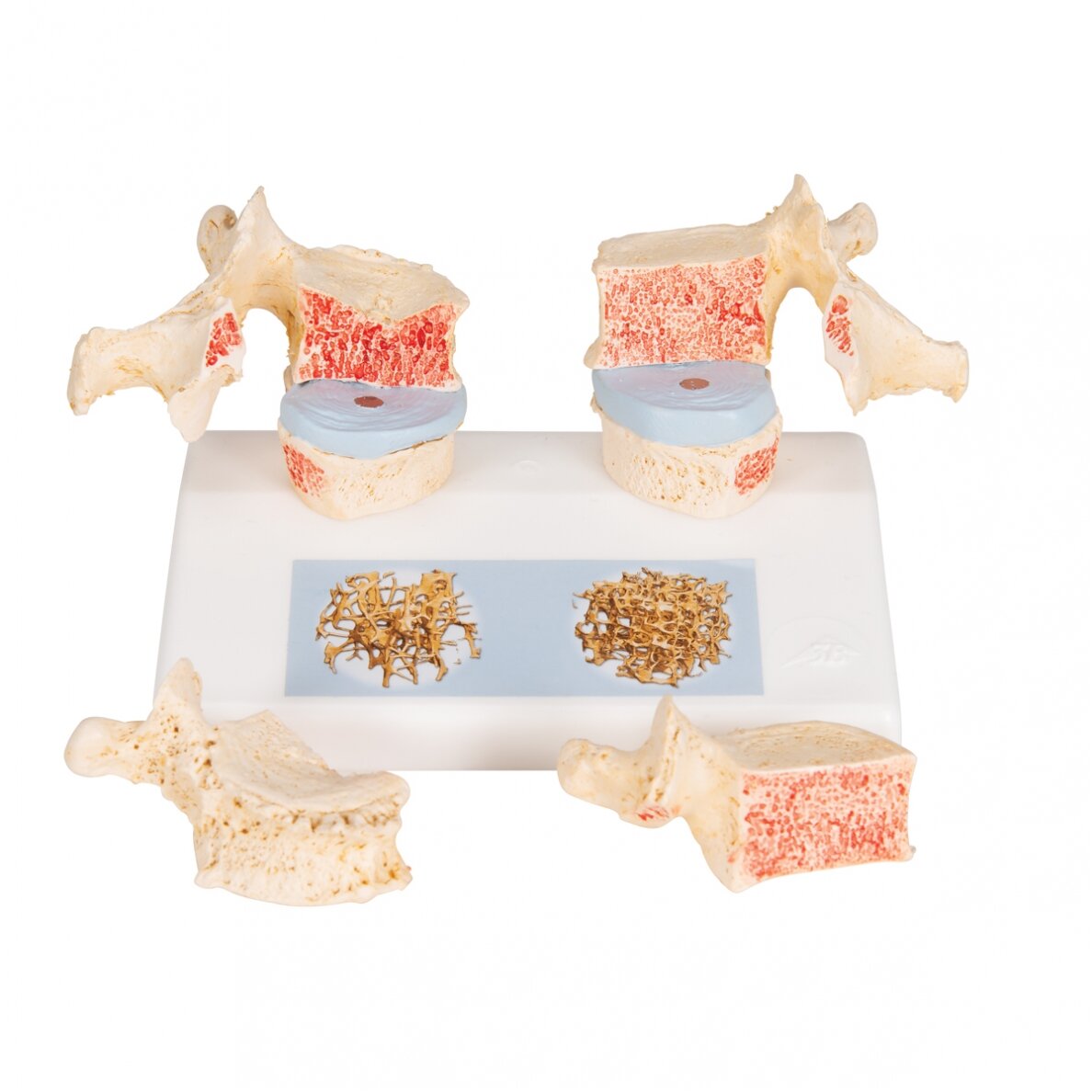Osteoporozės didaktinis modelis 6 Osteoporozės didaktinis modelis 6