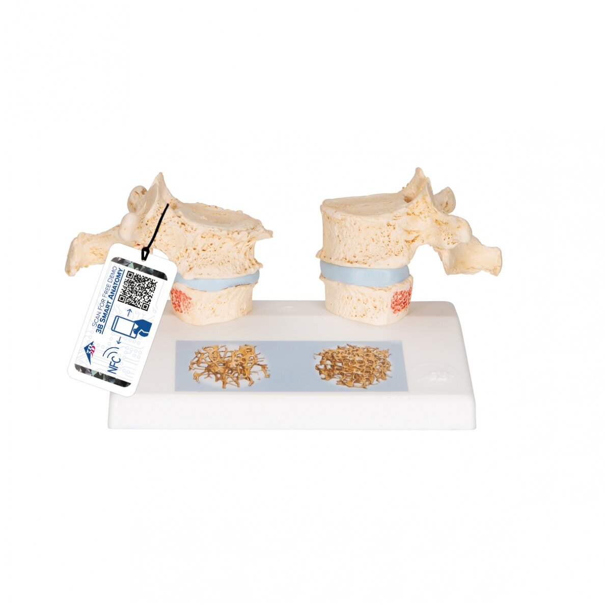Osteoporozės didaktinis modelis Osteoporozės didaktinis modelis