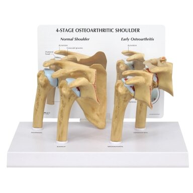 Osteoartritinio (OA) peties modelis - 4 stadijos Osteoartritinio (OA) peties modelis - 4 stadijos