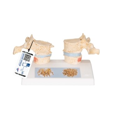 Osteoporozės didaktinis modelis Osteoporozės didaktinis modelis