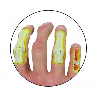 Osteoartritinės rankos modelis 1