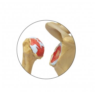 Osteoartritinio (OA) peties modelis - 4 stadijos 1 Osteoartritinio (OA) peties modelis - 4 stadijos 1