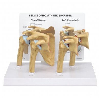 Osteoartritinio (OA) peties modelis - 4 stadijos Osteoartritinio (OA) peties modelis - 4 stadijos