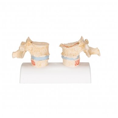 Osteoporozės didaktinis modelis 4