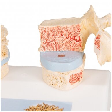 Osteoporozės didaktinis modelis 7 Osteoporozės didaktinis modelis 7
