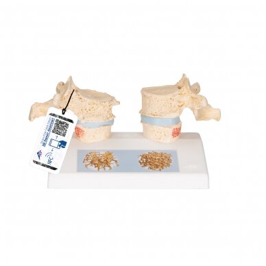 Osteoporozės didaktinis modelis