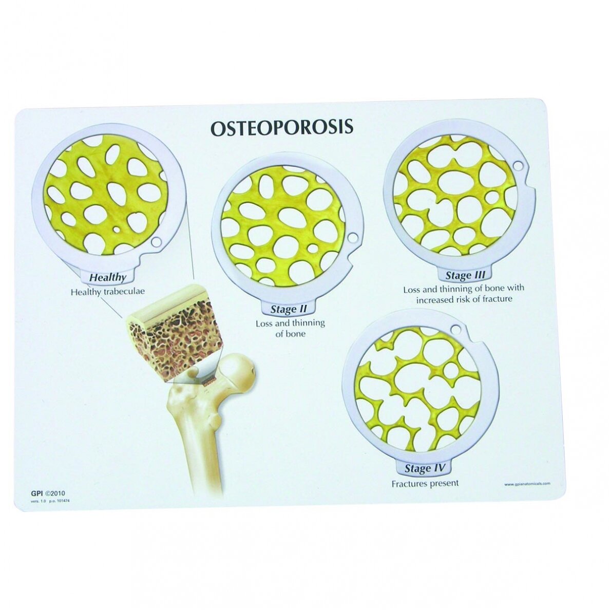 Pakabinamų diskų rinkinys - 4 osteoporozės stadijos 2 Pakabinamų diskų rinkinys - 4 osteoporozės stadijos 2