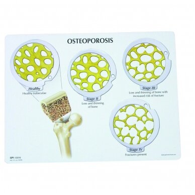 Pakabinamų diskų rinkinys - 4 osteoporozės stadijos 2