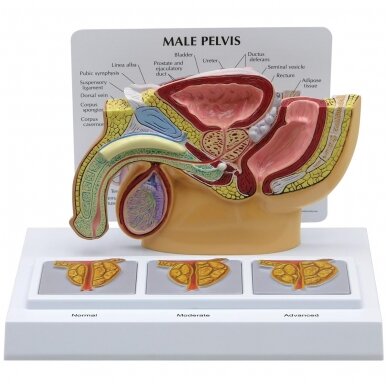 Vyro dubens skerspjūvis su 3D prostatos rėmu Vyro dubens skerspjūvis su 3D prostatos rėmu