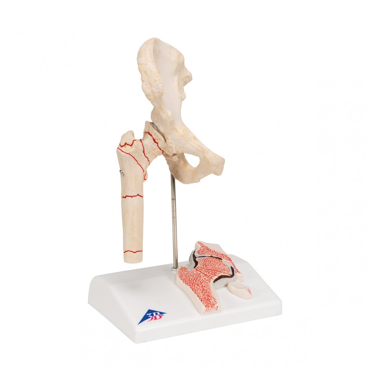 Žmogaus šlaunikaulio lūžio ir klubo osteoartrito modelis 2 Žmogaus šlaunikaulio lūžio ir klubo osteoartrito modelis 2