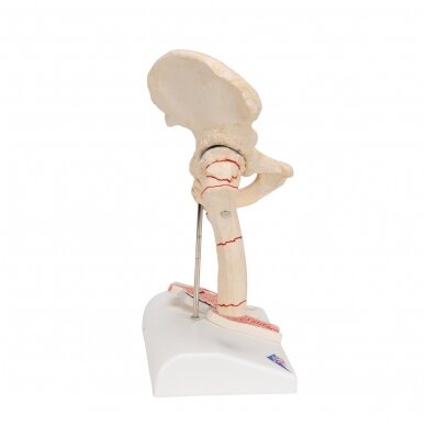 Žmogaus šlaunikaulio lūžio ir klubo osteoartrito modelis 3