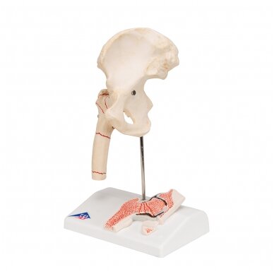 Žmogaus šlaunikaulio lūžio ir klubo osteoartrito modelis 4 Žmogaus šlaunikaulio lūžio ir klubo osteoartrito modelis 4