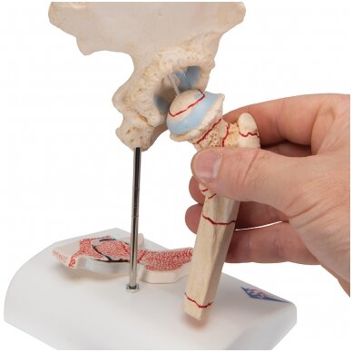 Žmogaus šlaunikaulio lūžio ir klubo osteoartrito modelis 7 Žmogaus šlaunikaulio lūžio ir klubo osteoartrito modelis 7