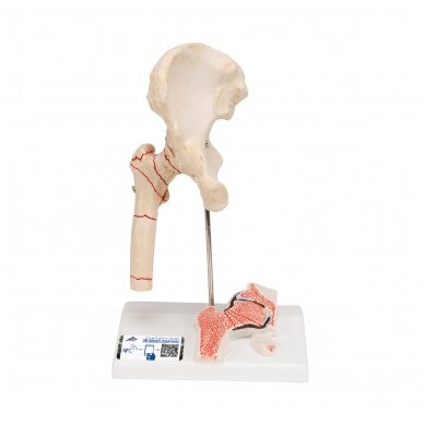 Žmogaus šlaunikaulio lūžio ir klubo osteoartrito modelis Žmogaus šlaunikaulio lūžio ir klubo osteoartrito modelis